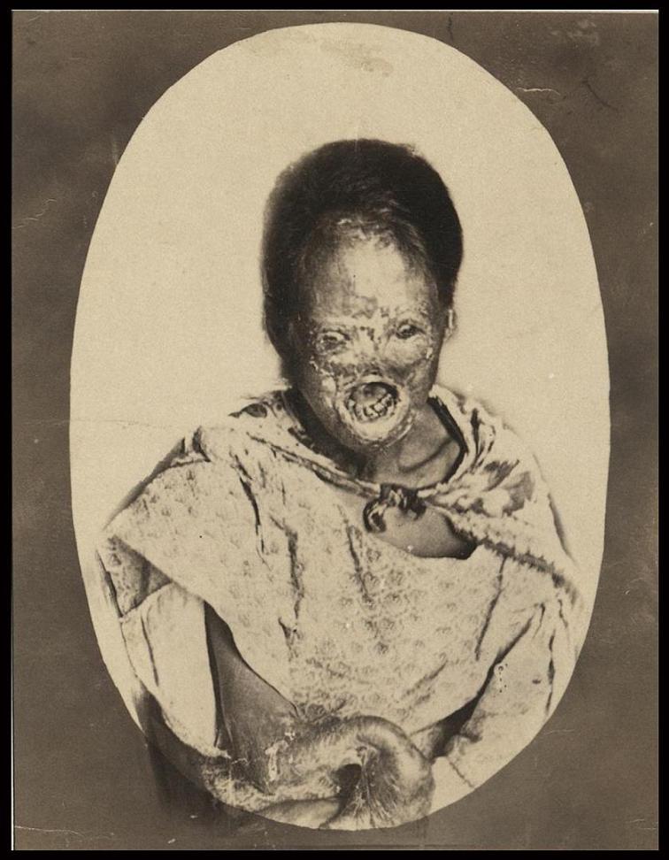 Leper woman.