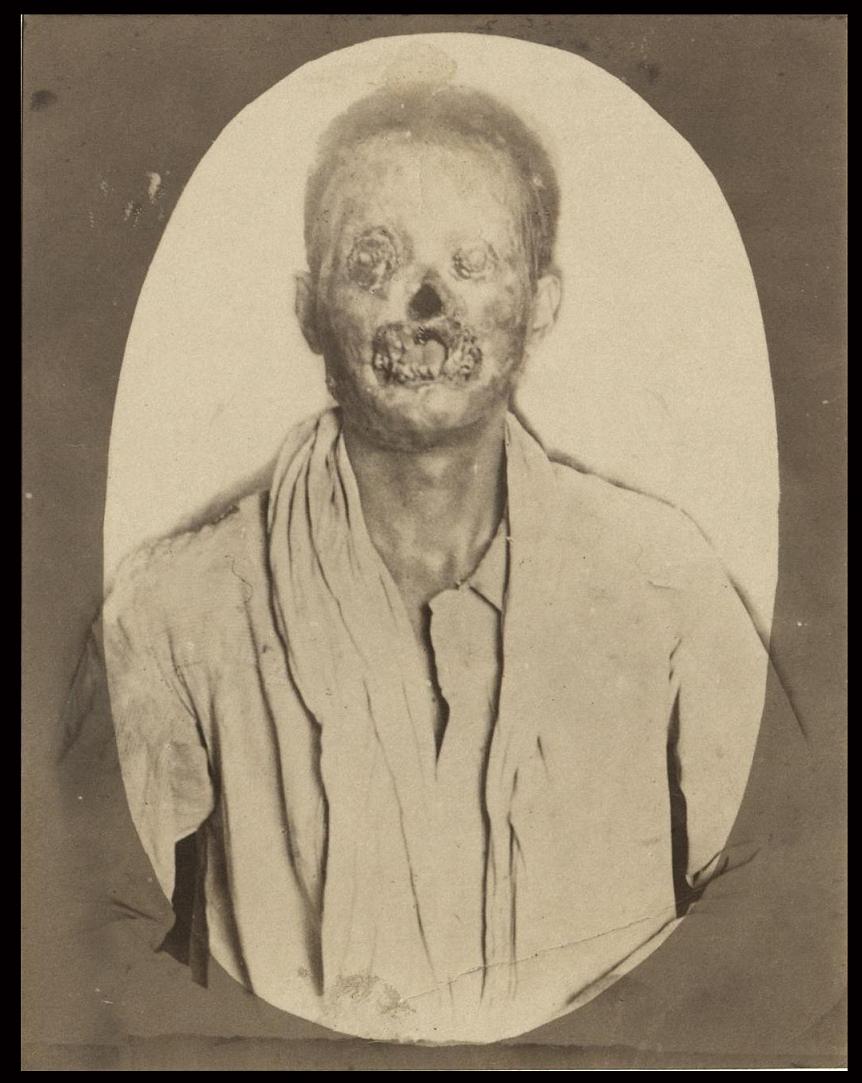 Leper man.