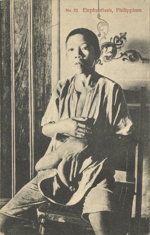 No. 23. Elephantiasis, Philippines.