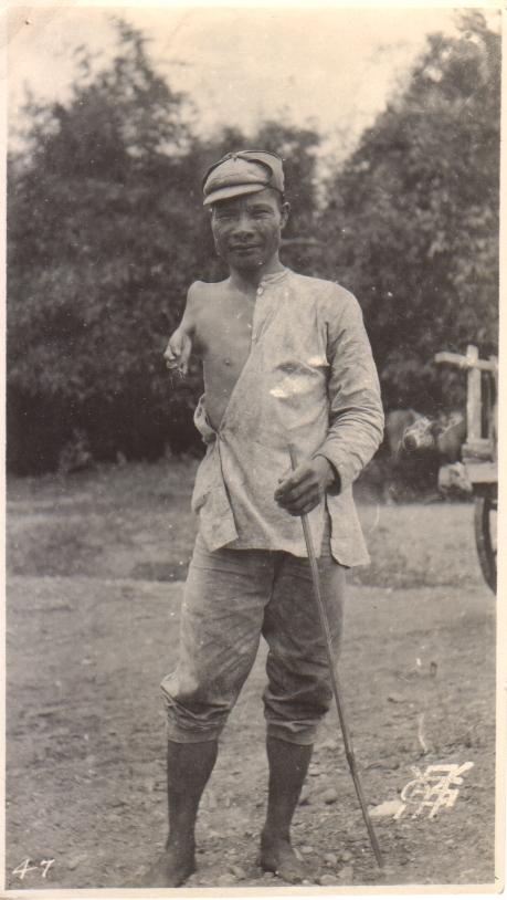 47. [Untitled – Filipino man with a disfigured right arm].